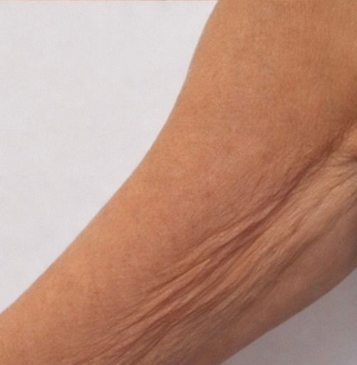 Upper-Arm Firmness Reference before