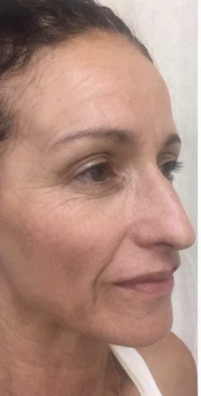 Lines, Lift & Tone Progress after