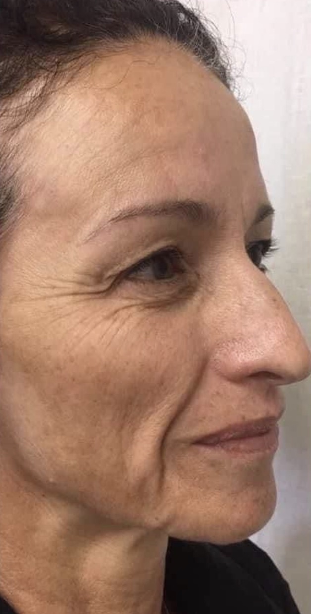 Lines, Lift & Tone Progress before