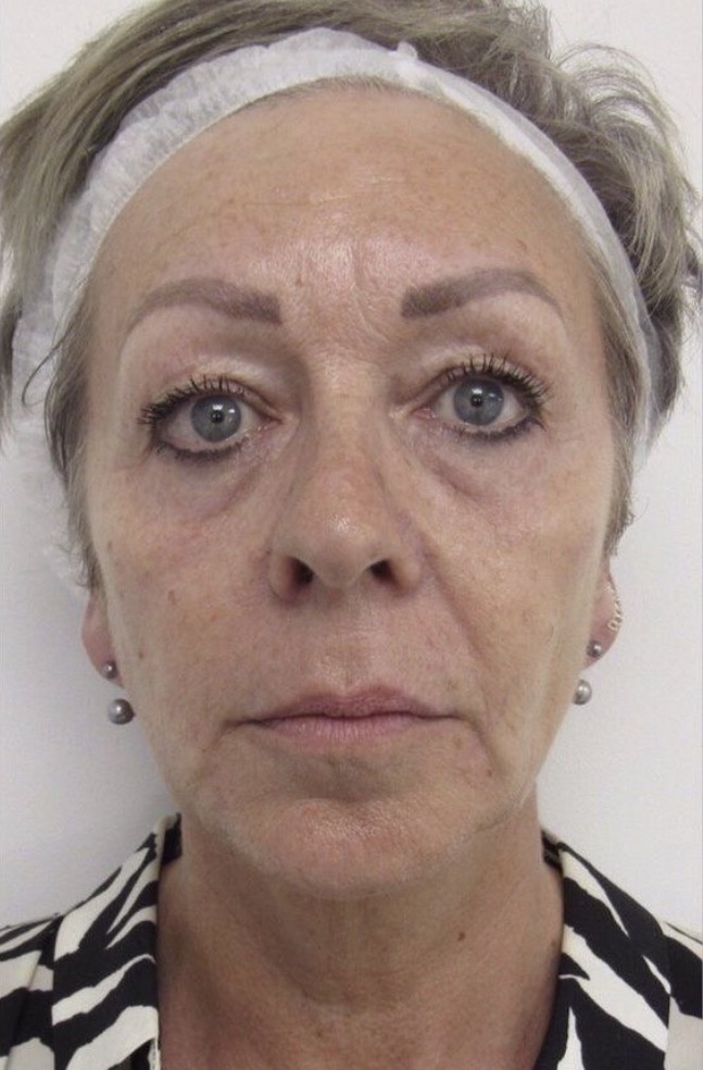 Facial Firmness & Tone Progress after