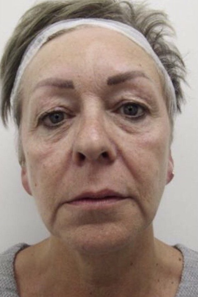 Facial Firmness & Tone Progress before